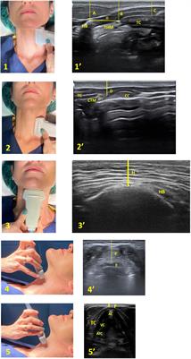 A new score for airway assessment using clinical and ultrasound parameters